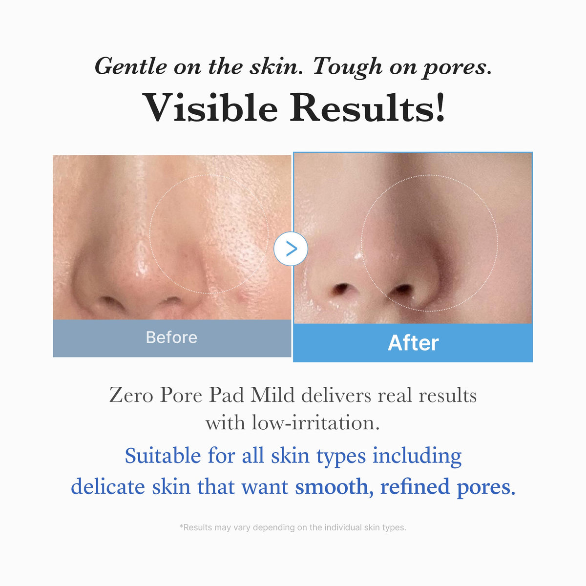 Zero Pore Madecassoside Pads (Mild)